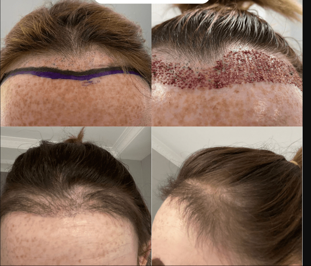 Female Hair Transplant